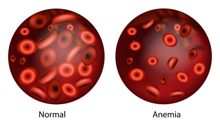 What Does Anemia Do to Your Body? - HealthRemedy123 | Easy Health & Remedy