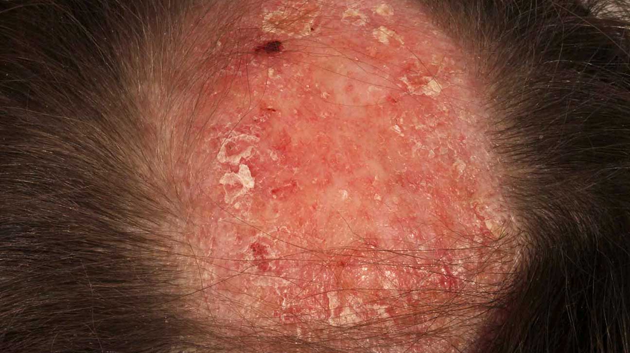 Symptoms and Causes for Sores on the Scalp - HealthRemedy123 | Easy ...