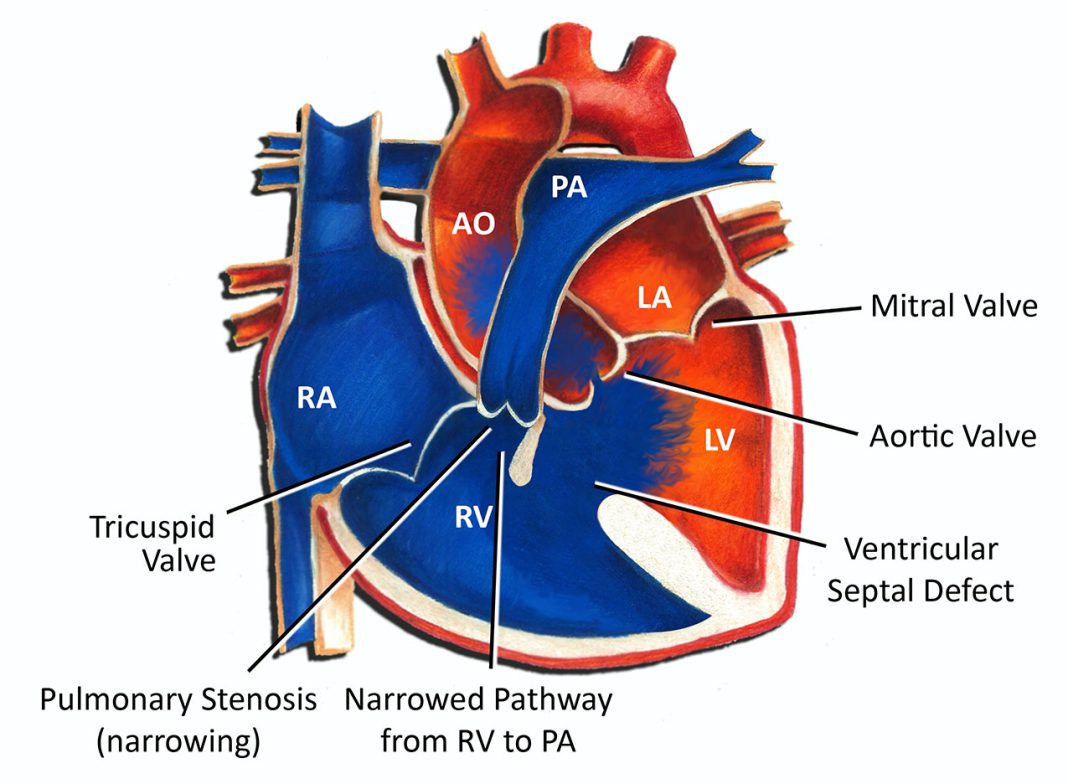 Tetralogy of Fallot Surgical Procedure - HealthRemedy123 | Easy Health ...