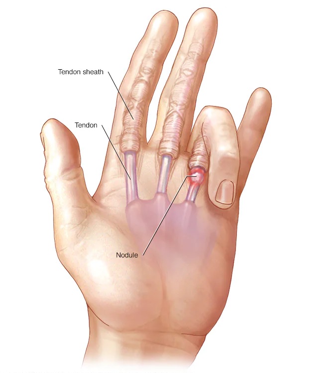 locking-finger-joints-and-trigger-finger-arthritis-healthremedy123